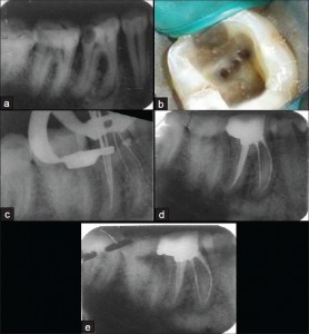 3 distal canals in mpolar